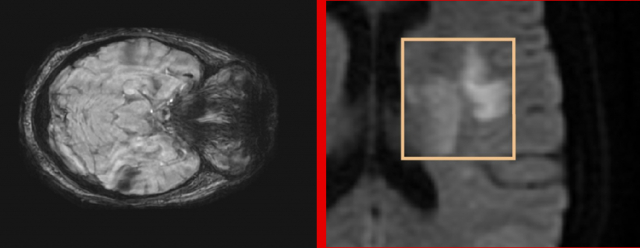 Figure 1: (a) Visualization of a lesion on a diffusion MRI showing the different stages of development. Most publications deal only with well-developed lesions that take advantage of high intensity boundaries (2b) For the hyperacute phase, weak or zero borders and low intensities complicate the task of segmentation.