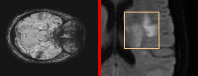 Figure 1: (a) Visualization of a lesion on a diffusion MRI showing the different stages of development. Most publications deal only with well-developed lesions that take advantage of high intensity boundaries (2b) For the hyperacute phase, weak or zero borders and low intensities complicate the task of segmentation.