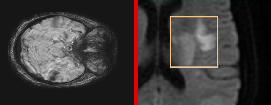 Figure 1: (a) Visualization of a lesion on a diffusion MRI showing the different stages of development. Most publications deal only with well-developed lesions that take advantage of high intensity boundaries (2b) For the hyperacute phase, weak or zero borders and low intensities complicate the task of segmentation.