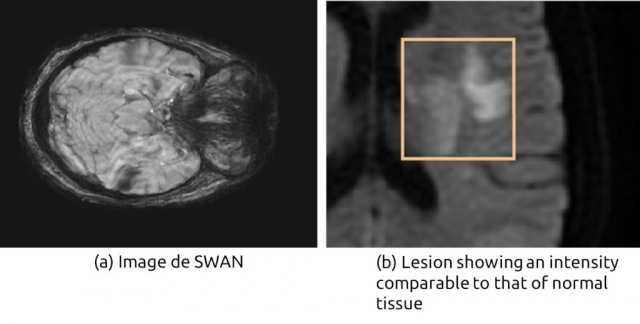 Figure 1: (a) Visualization of a lesion on a diffusion MRI showing the different stages of development. Most publications deal only with well-developed lesions that take advantage of high intensity boundaries (2b) For the hyperacute phase, weak or zero borders and low intensities complicate the task of segmentation.