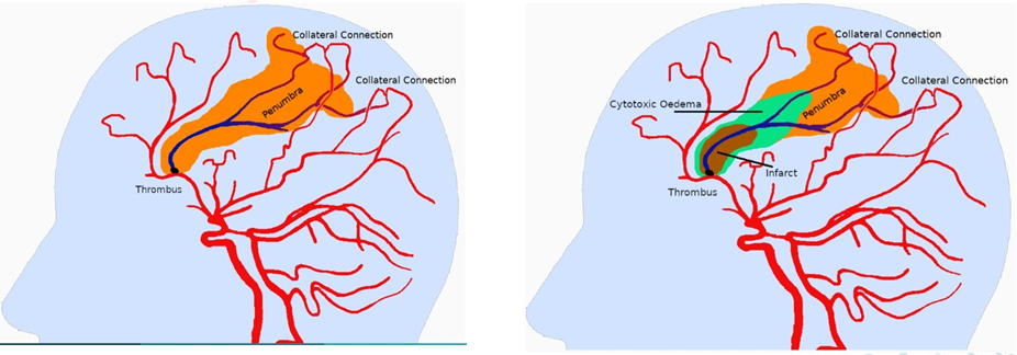 Figure 1: Evolution of an Ischemic Stroke