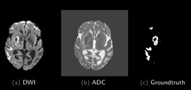 Figure 1: Lesion segmentation using ADC and DWI