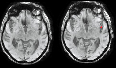 Figure 2: Thrombus segmentation using SWAN.