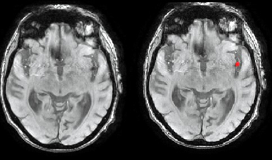 Figure 2: Thrombus segmentation using SWAN.