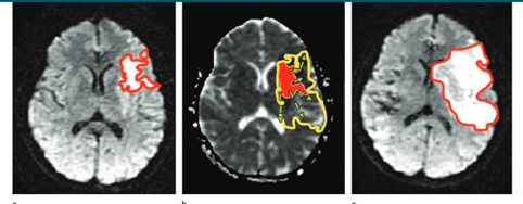 Figure 3: Lesion growth over time