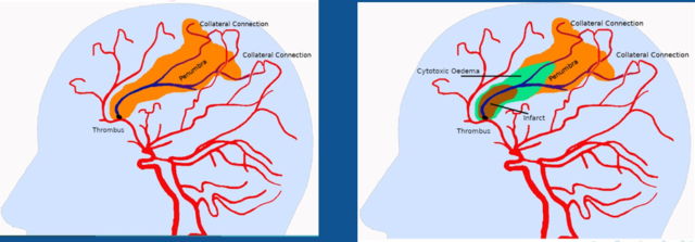 Figure 1: Evolution of an Ischemic Stroke