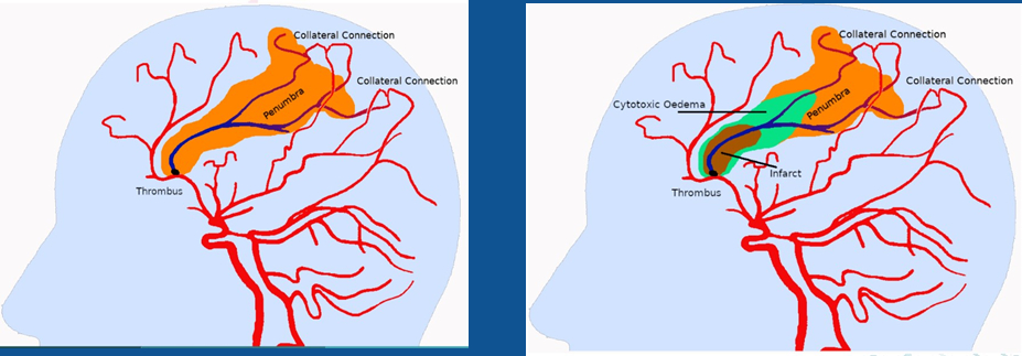 Figure 1: Evolution of an Ischemic Stroke
