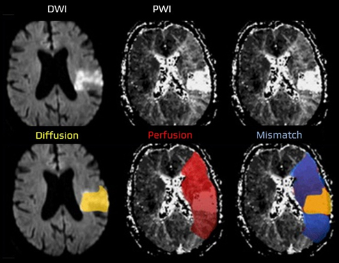 Figure 1: DWI-PWI mismatch Figure 1: DWI-PWI mismatch